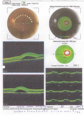 Central Serous Retinopathy