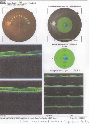 Central Serous Retinopathy