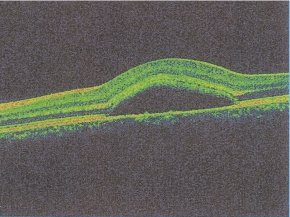 Central Serous Retinopathy