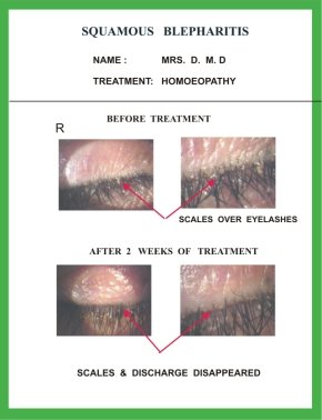 Blepharitis