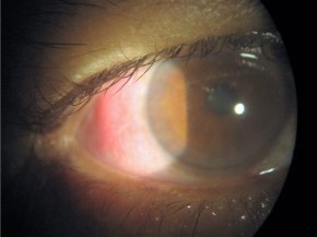 Episcleritis