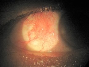 Episcleritis