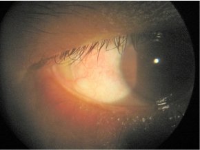 Episcleritis