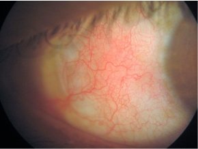 Episcleritis